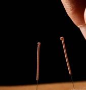 acupuncture in preston